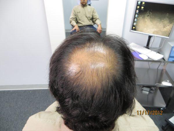 Alvin Escobar Feels Good About Scalp Med