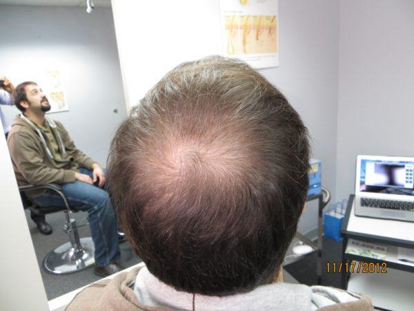 Andrew Berkovich’s Disappearing Bald Spot