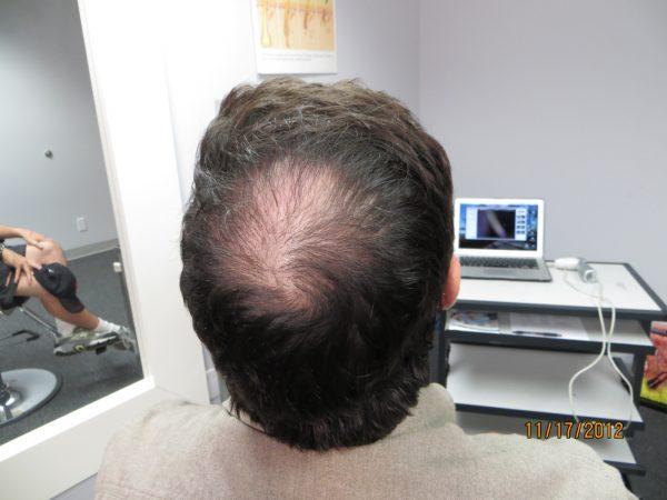 Frank Mercuri Says, “Scalp Med Will Change the Future for Many People”