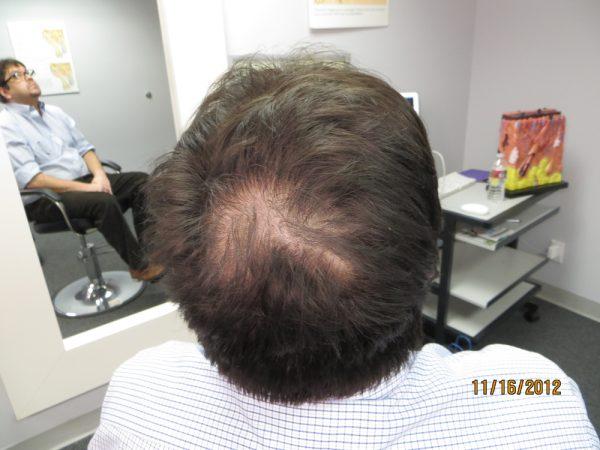 Gustavo Chanampa Has New Hair Follicles