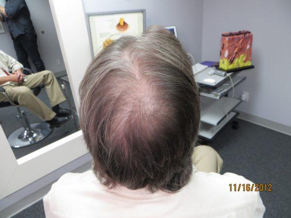 Kelly McCracken is Ecstatic About His Scalp Med Results!