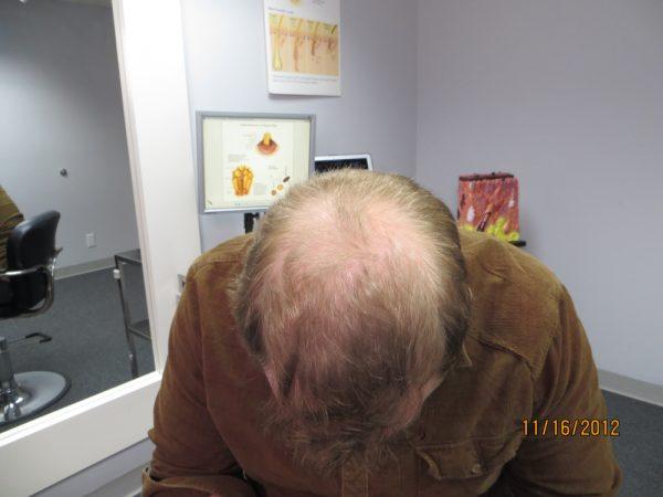 Zack Daly is Growing Hair on His Crown