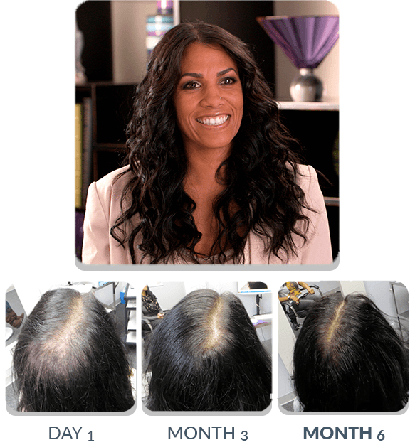 PATENTED HAIR REGROWTH SYSTEM FOR WOMEN CS ScalpMED