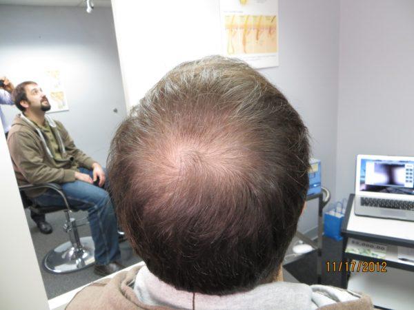 Andrew Berkovich’s Disappearing Bald Spot