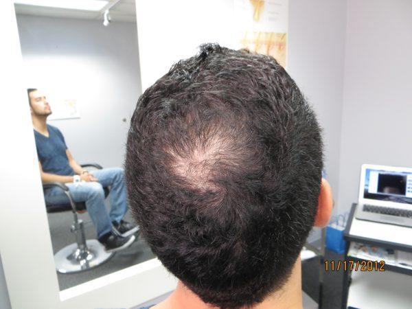 Francisco Saw Hair Regrowth in Only 2-Months!*
