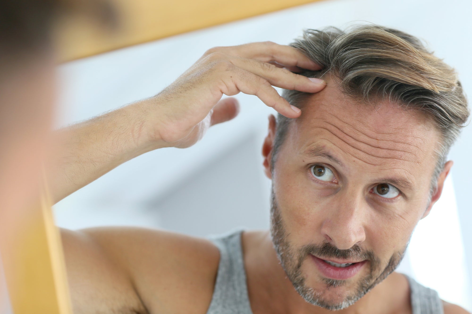 Hair Loss in Men: What You Need to Know