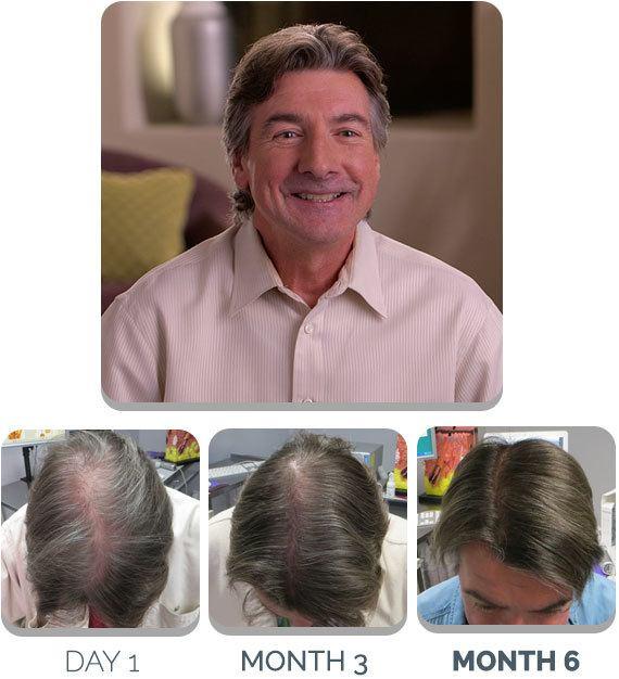 PATENTED HAIR REGROWTH SYSTEM FOR MEN For Men Scalp Med 