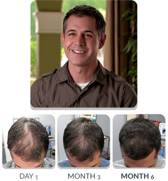 PATENTED HAIR REGROWTH SYSTEM FOR MEN For Men Scalp Med 