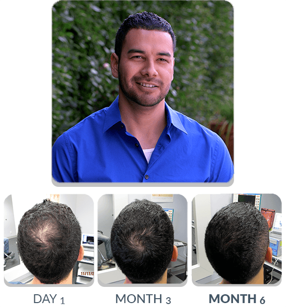 PATENTED HAIR REGROWTH SYSTEM FOR MEN (SPECIAL TV OFFER) For Men Scalp Med 