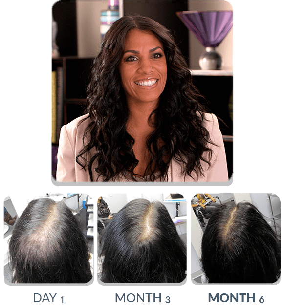 PATENTED HAIR REGROWTH SYSTEM FOR WOMEN For Women Scalp Med 